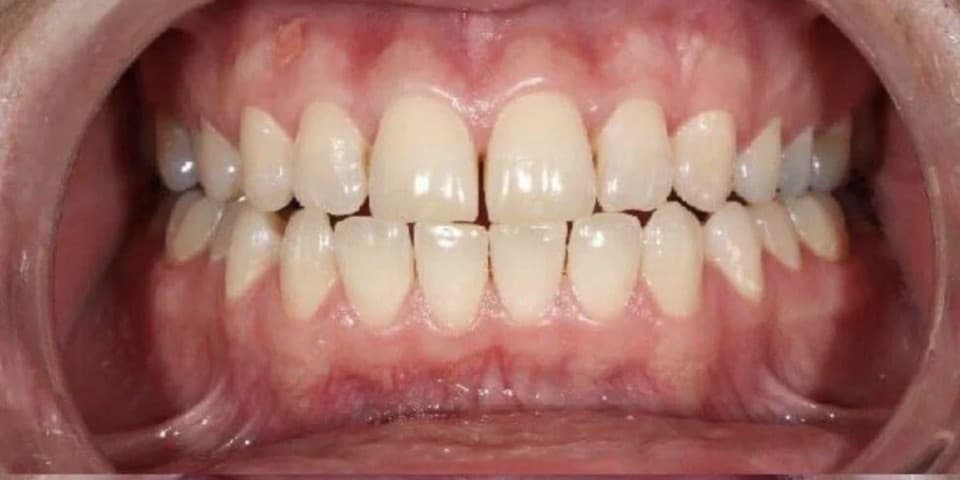 Teeth before WhitenPro Clinic treatment