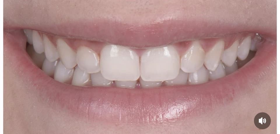 Teeth after WhitenPro Home treatment