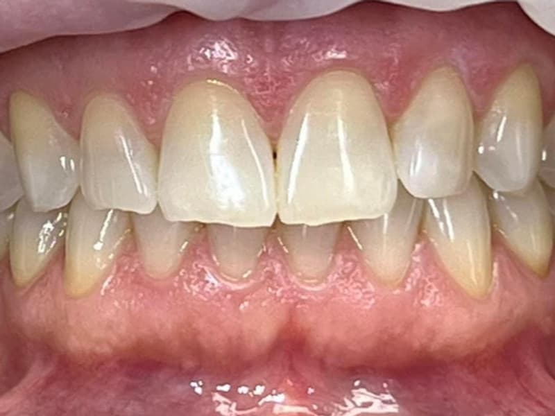 Teeth after WhitenPro Home Sensitive treatment
